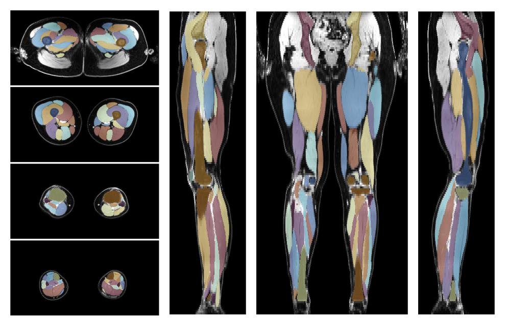 Overlay of automated muscle segmentation labels on dixon water image.